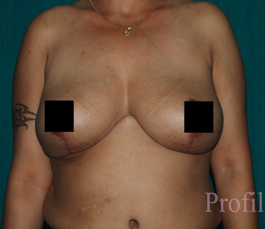breast-reduction-after