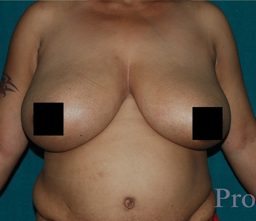 breast-reduction-before