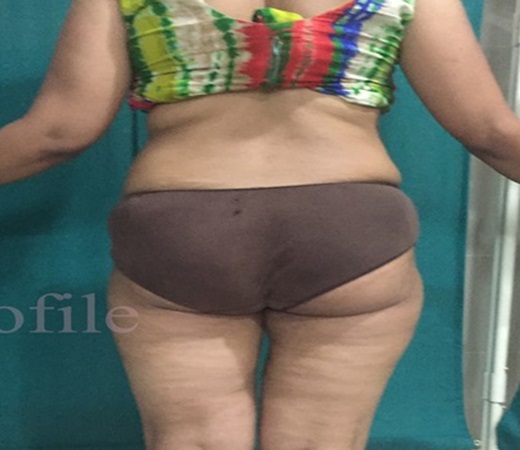 liposuction-after