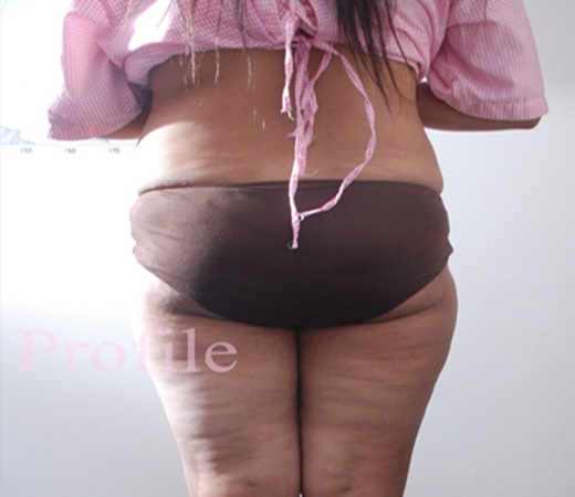 liposuction-before